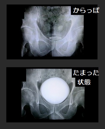 膀胱のエックス線写真